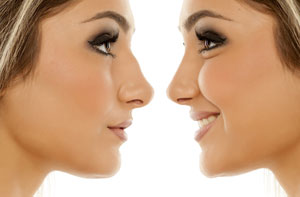Rhinoplasty Whitefield Greater Manchester (M45)