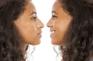 Rhinoplasty Newton Mearns Scotland (G77) Rhinoplasty Newton Mearns Scotland (G77)