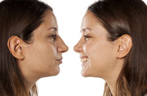 Rhinoplasty Radcliffe Greater Manchester (M26)