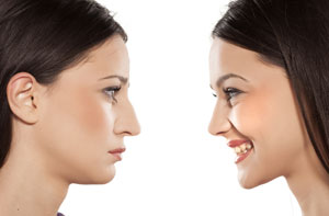 Rhinoplasty Whitefield Greater Manchester (M45)