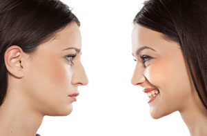 Rhinoplasty Tunbridge Wells Kent (TN1)